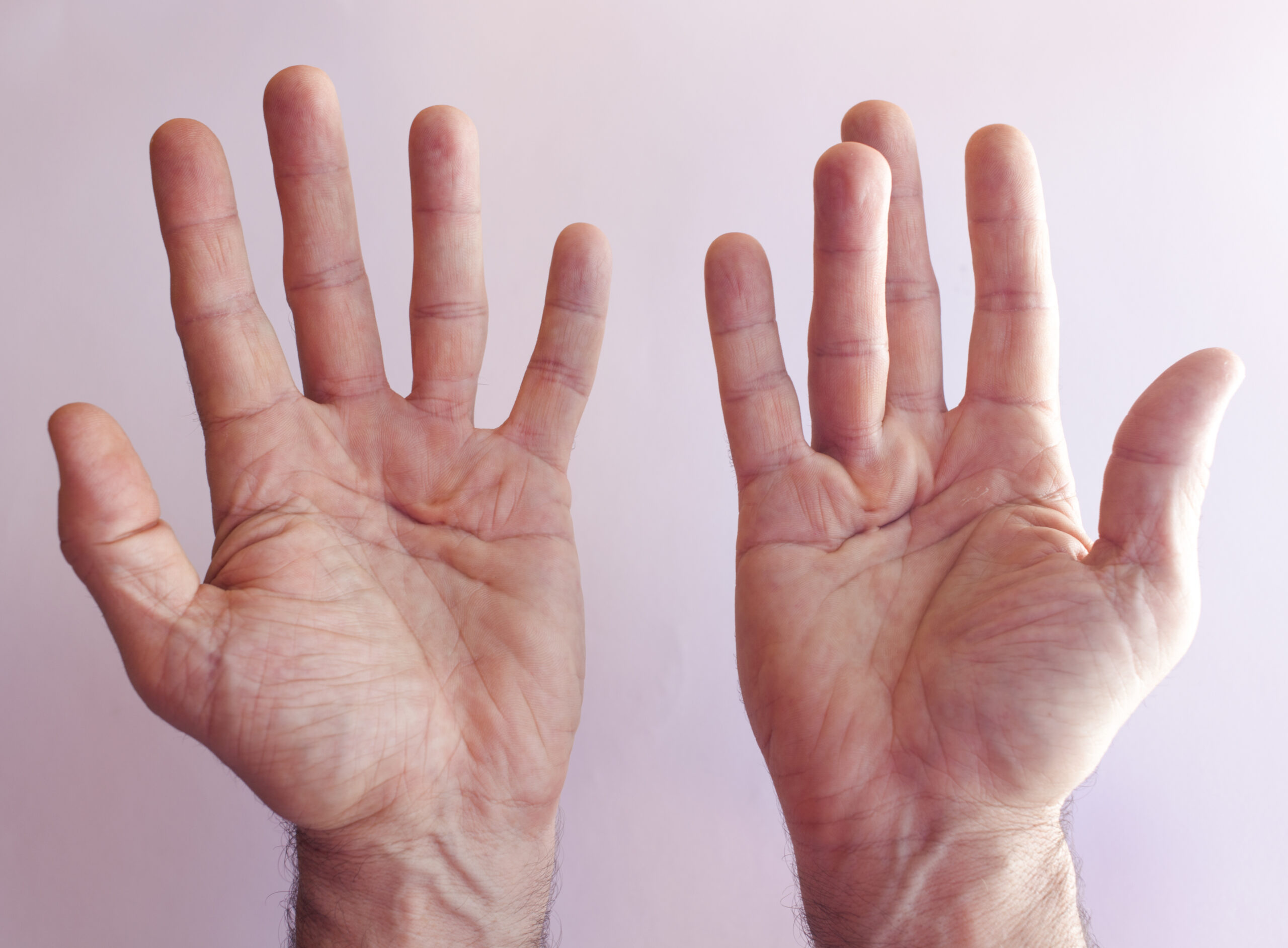 hands showing dupuytrens
