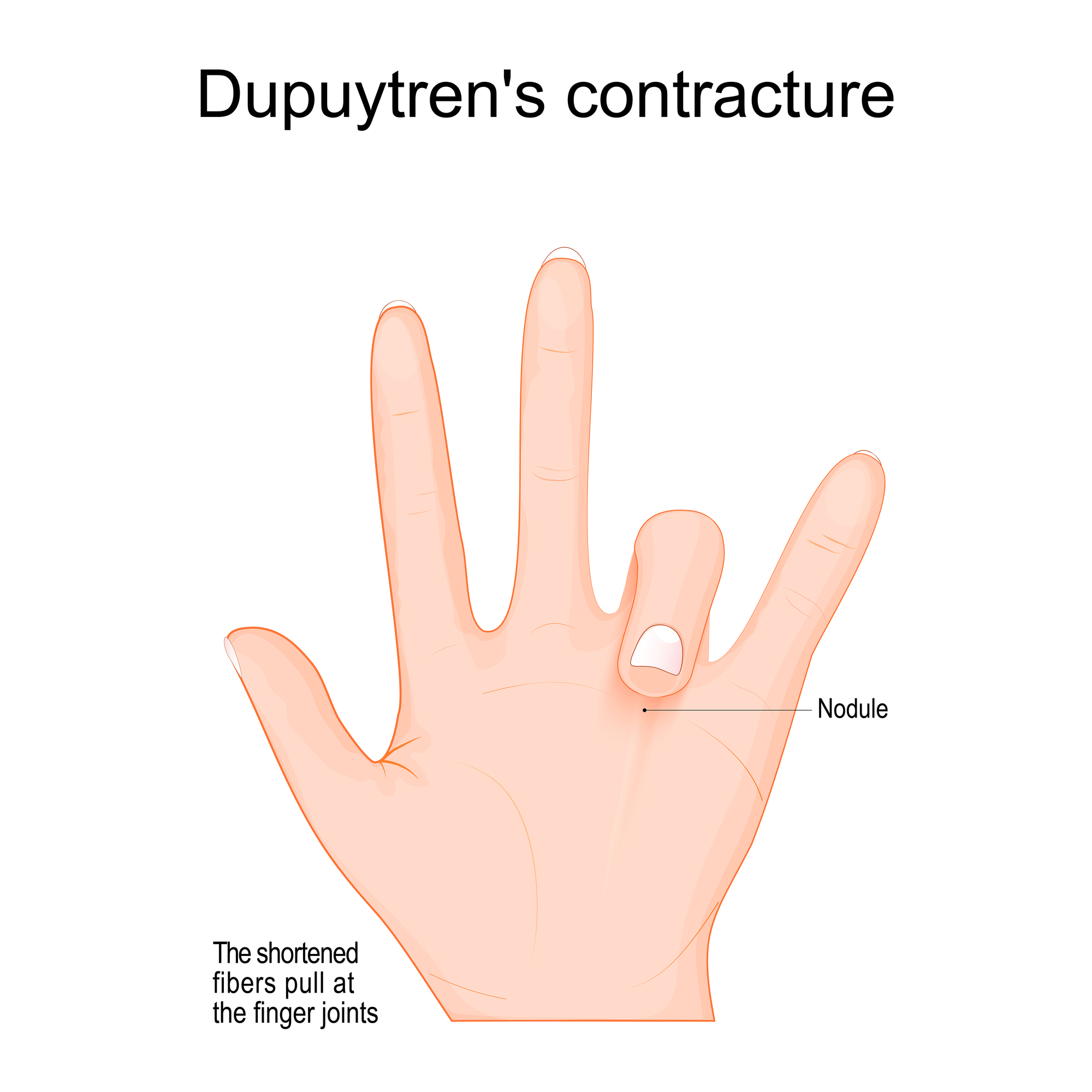 Dupuytren's contracture in left hand.